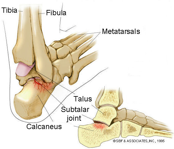 Ankle Sprain Rehabilitation - PHYSIOTHERAPY PERSPECTIVE